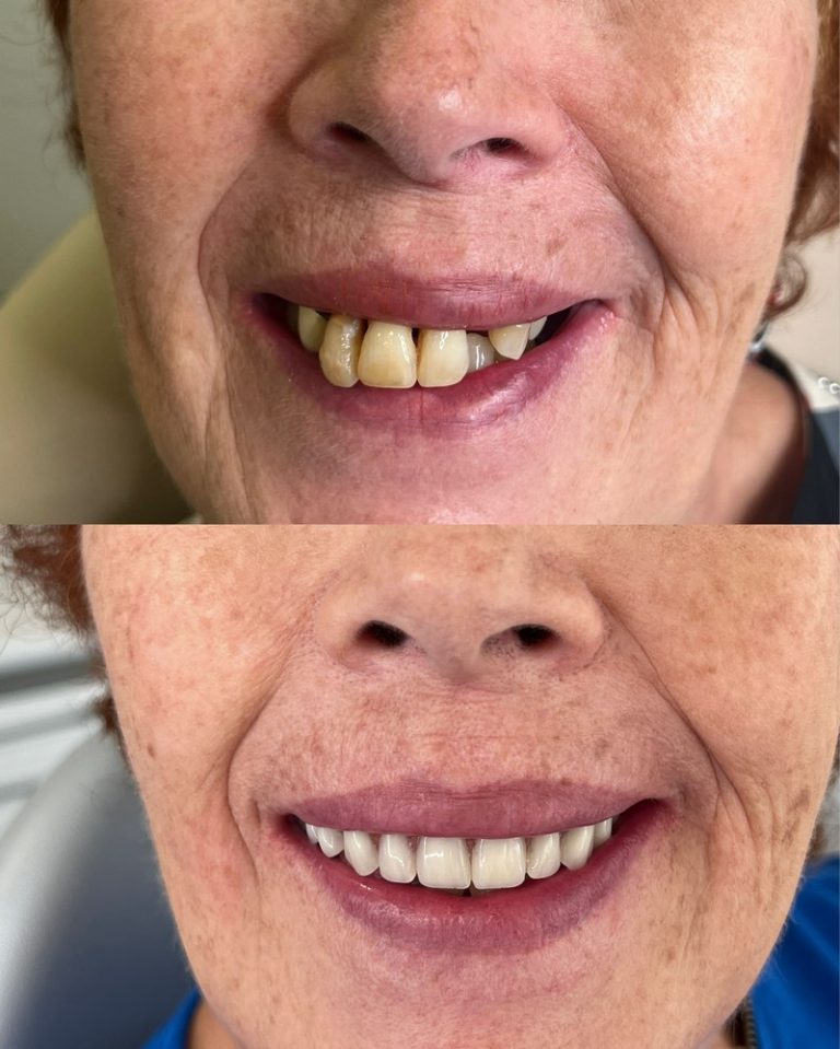 Implantes dentales antes y después – Dra. Elsa Birnbaum, Villaverde (Madrid)