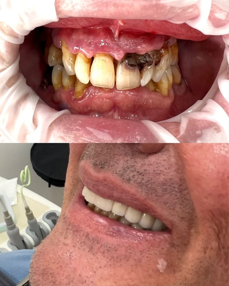 Implantes dentales antes y después – Dra. Elsa Birnbaum, Villaverde (Madrid)