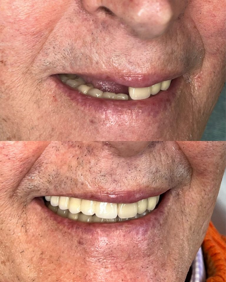 Implantes dentales antes y después – Dra. Elsa Birnbaum, Villaverde (Madrid)