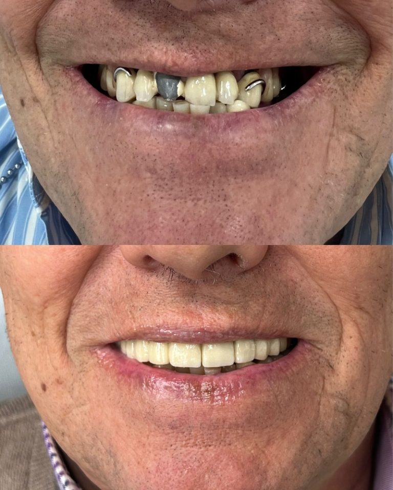Implantes dentales antes y después – Dra. Elsa Birnbaum, Villaverde (Madrid)