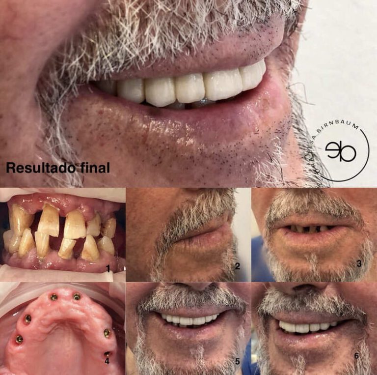 Implantes dentales antes y después – Dra. Elsa Birnbaum, Villaverde (Madrid)