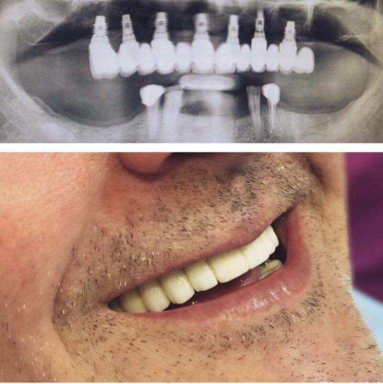 Implantes dentales antes y después – Dra. Elsa Birnbaum, Villaverde (Madrid)