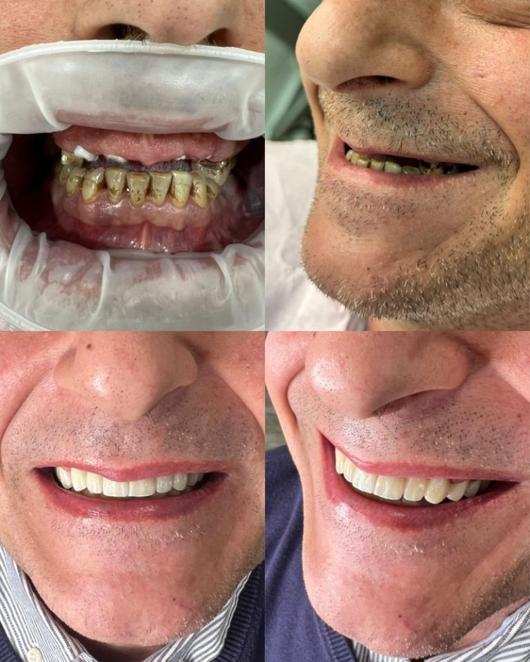 Implantes dentales antes y después – Dra. Elsa Birnbaum, Villaverde (Madrid)
