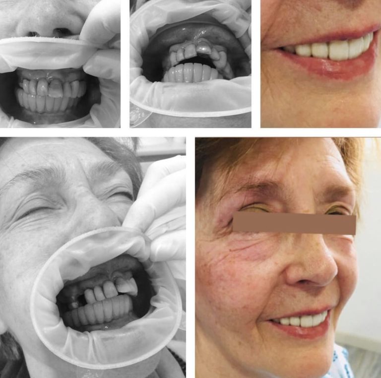 Implantes dentales antes y después – Dra. Elsa Birnbaum, Villaverde (Madrid)