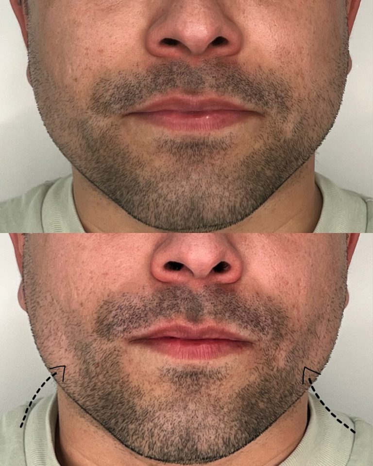Bichectomía antes y después – Dra. Elsa Birnbaum, Madrid