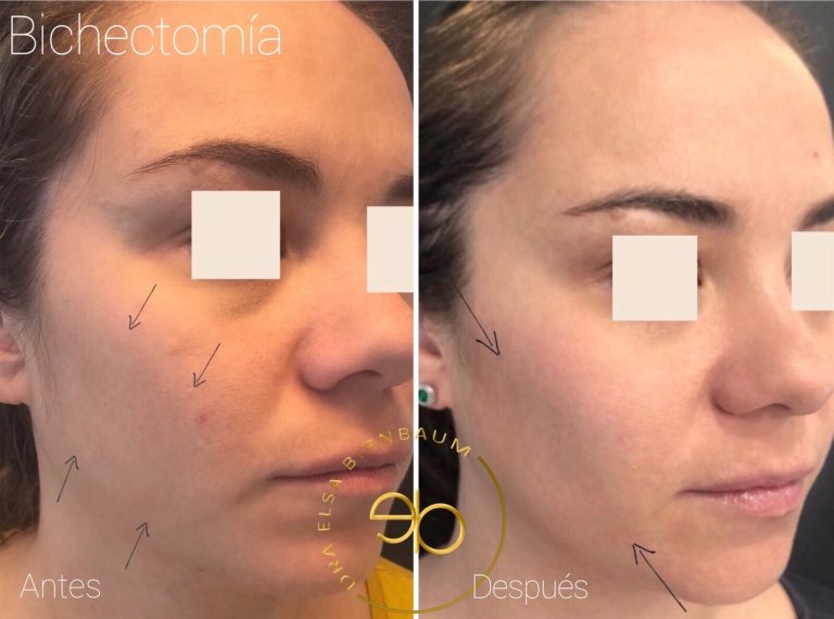 Bichectomía antes y después – Dra. Elsa Birnbaum, Madrid