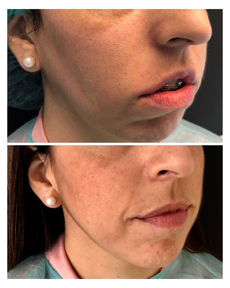 Bichectomía antes y después – Dra. Elsa Birnbaum, Madrid