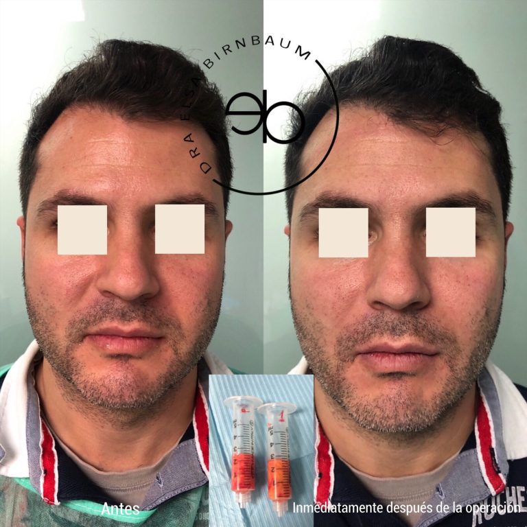 Bichectomía antes y después – Dra. Elsa Birnbaum, Madrid