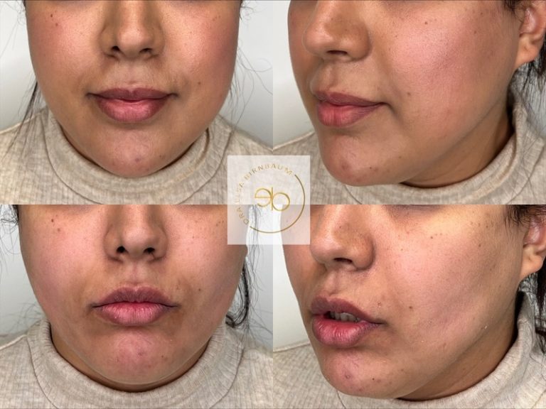 Bichectomía antes y después – Dra. Elsa Birnbaum, Madrid