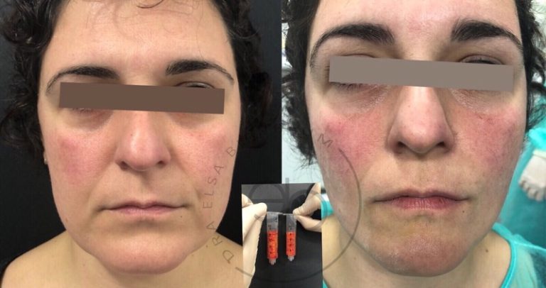 Bichectomía antes y después – Dra. Elsa Birnbaum, Madrid