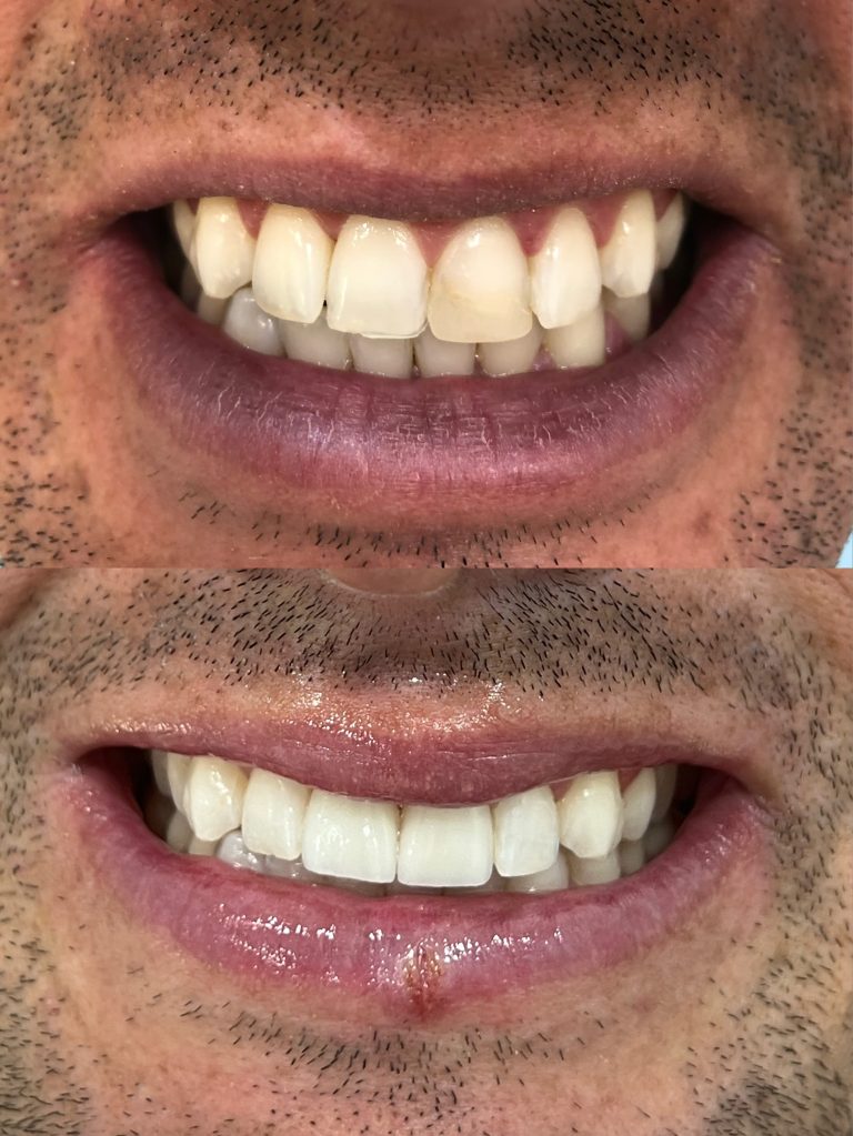 Carillas dentales antes y después – Dra. Elsa Birnbaum, Villaverde (Madrid)