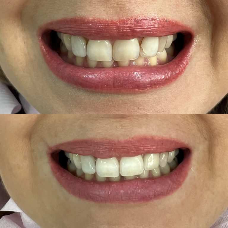 Carillas dentales antes y después – Dra. Elsa Birnbaum, Villaverde (Madrid)