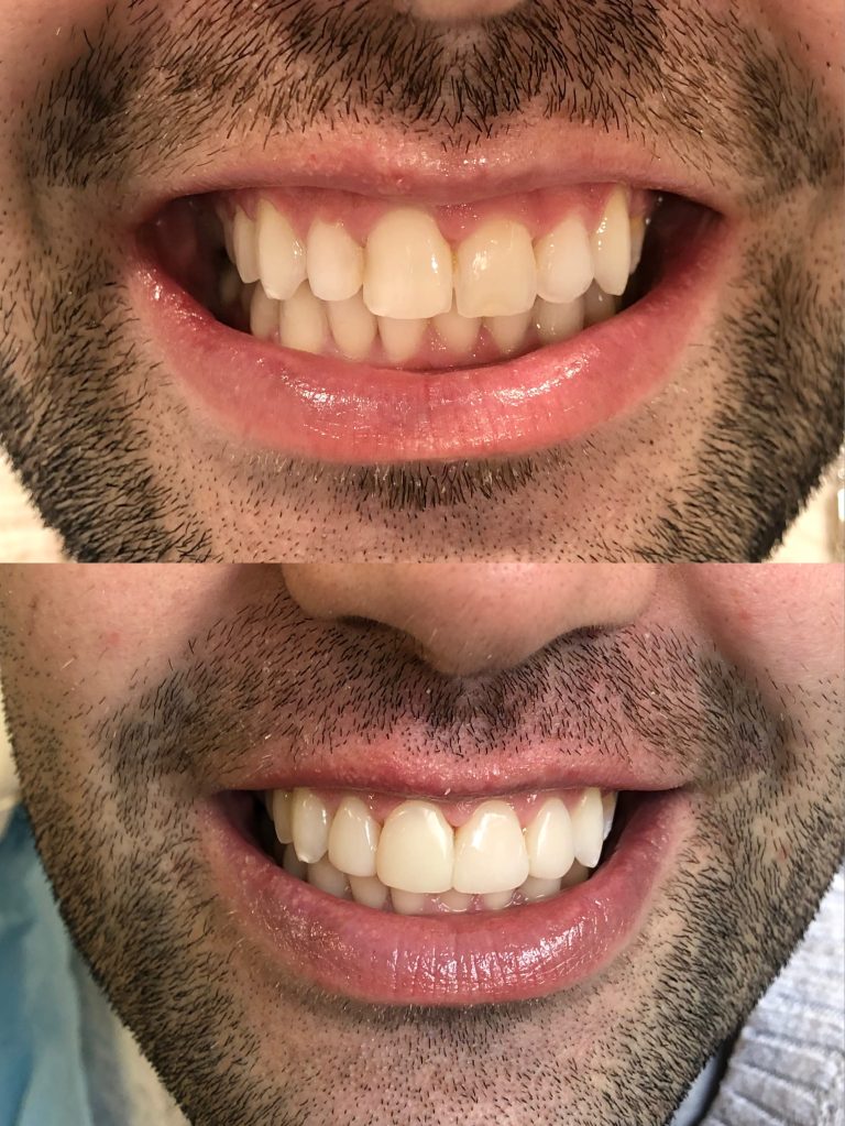 Carillas dentales antes y después – Dra. Elsa Birnbaum, Villaverde (Madrid)