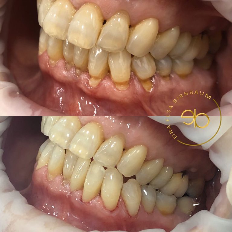 Carillas dentales antes y después – Dra. Elsa Birnbaum, Villaverde (Madrid)