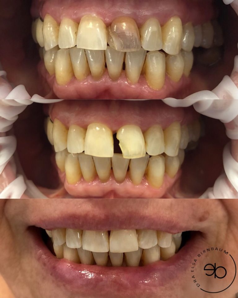Carillas dentales antes y después – Dra. Elsa Birnbaum, Villaverde (Madrid)