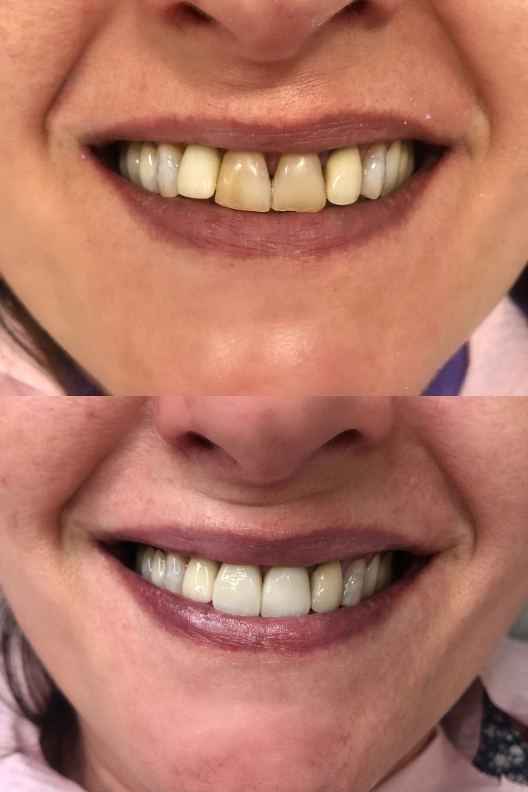 Carillas dentales antes y después – Dra. Elsa Birnbaum, Villaverde (Madrid)