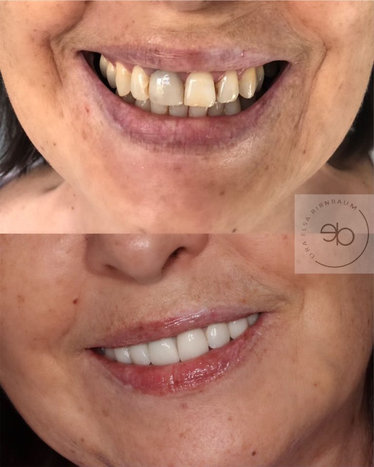 Carillas dentales antes y después – Dra. Elsa Birnbaum, Villaverde (Madrid)