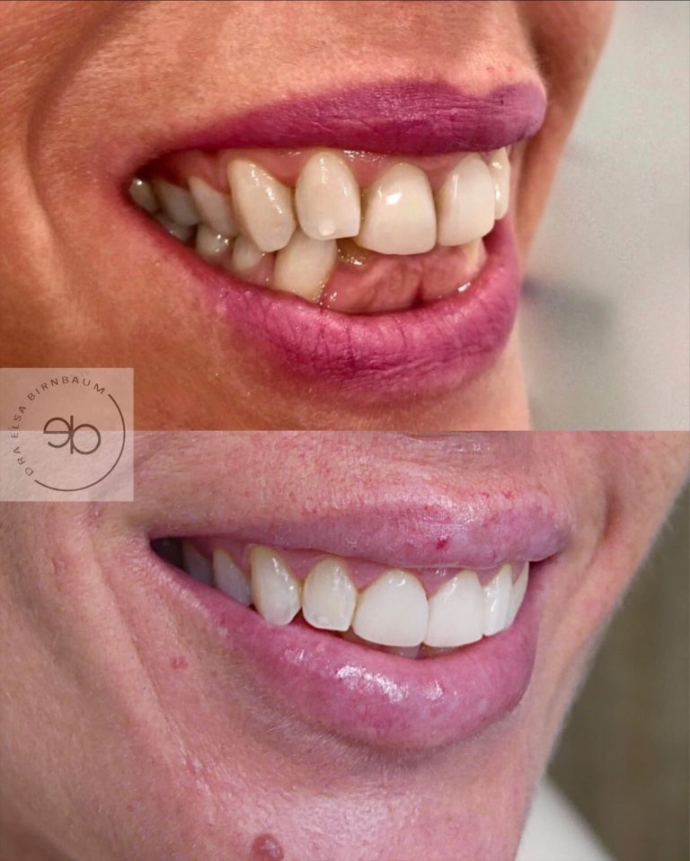Carillas dentales antes y después – Dra. Elsa Birnbaum, Villaverde (Madrid)