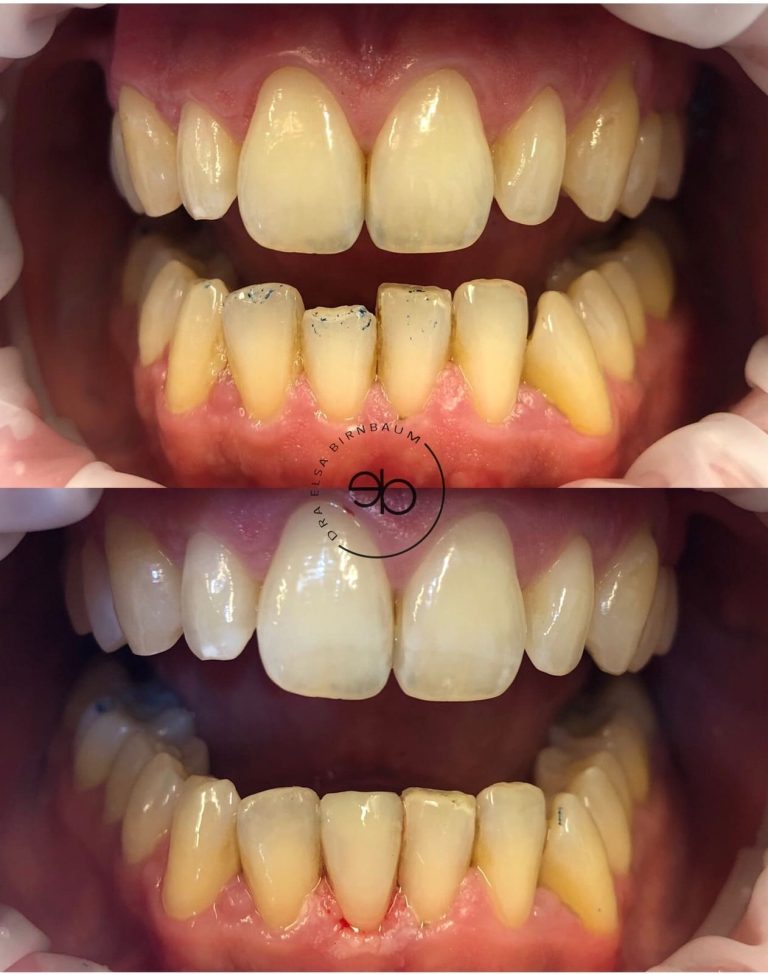 Carillas dentales antes y después – Dra. Elsa Birnbaum, Villaverde (Madrid)