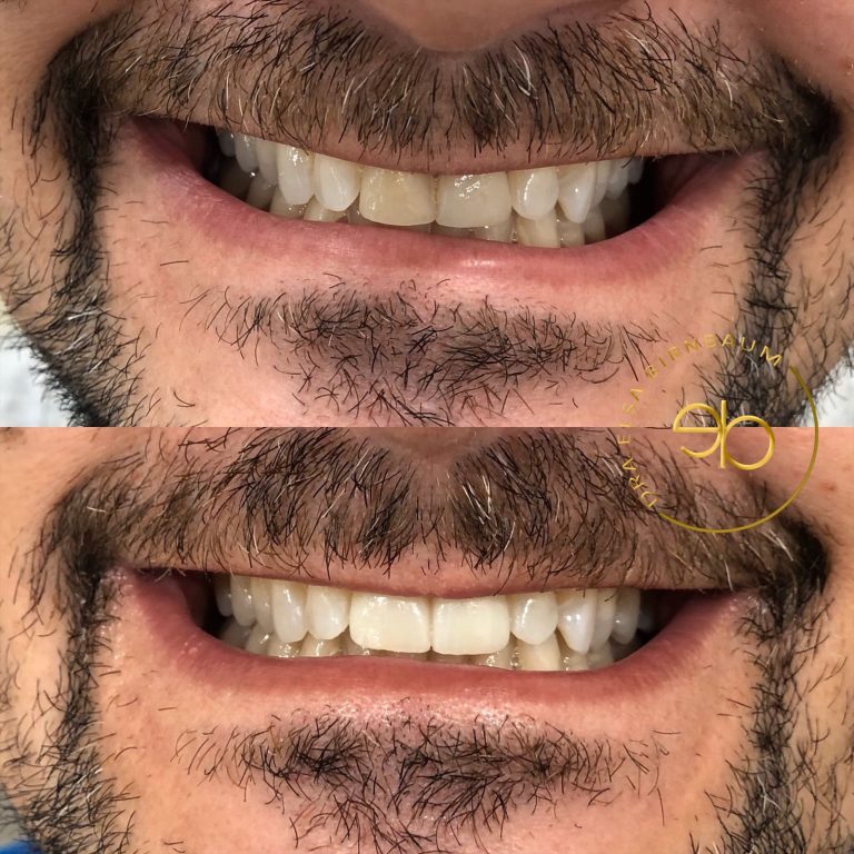 Carillas dentales antes y después – Dra. Elsa Birnbaum, Villaverde (Madrid)