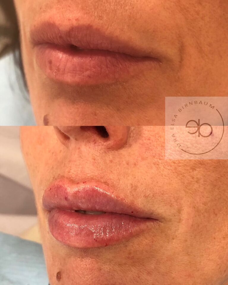 Ácido hialurónico en labios antes y después – Dra. Elsa Birnbaum, Madrid