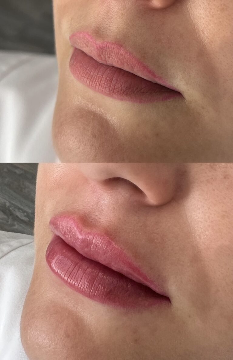 Ácido hialurónico en labios antes y después – Dra. Elsa Birnbaum, Madrid