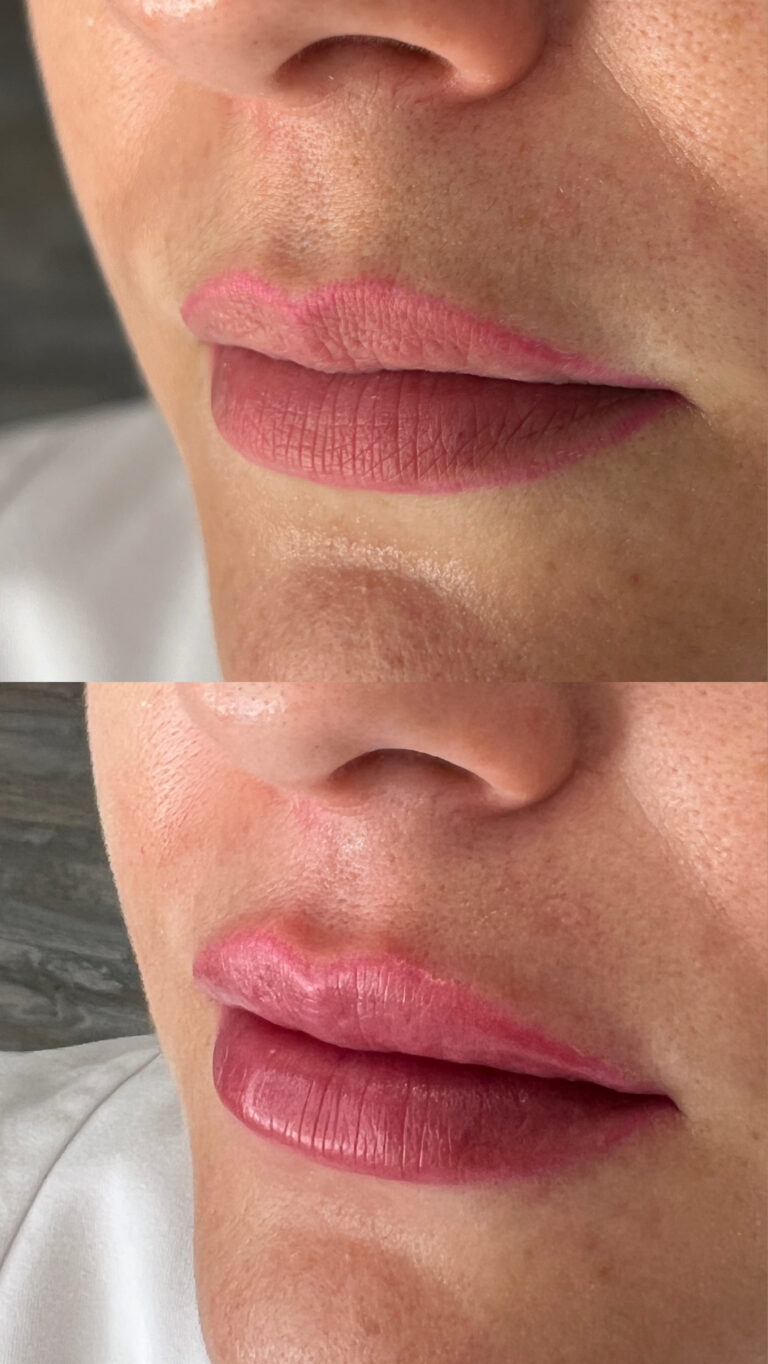 Ácido hialurónico en labios antes y después – Dra. Elsa Birnbaum, Madrid