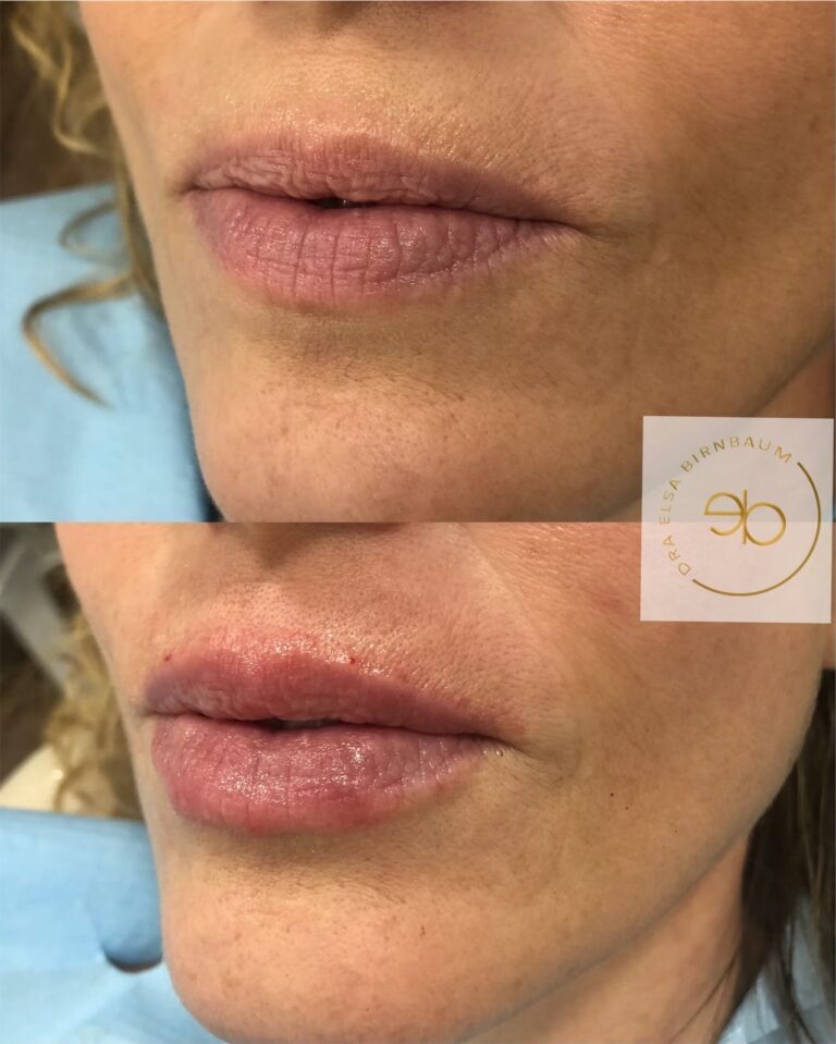 Ácido hialurónico en labios antes y después – Dra. Elsa Birnbaum, Madrid