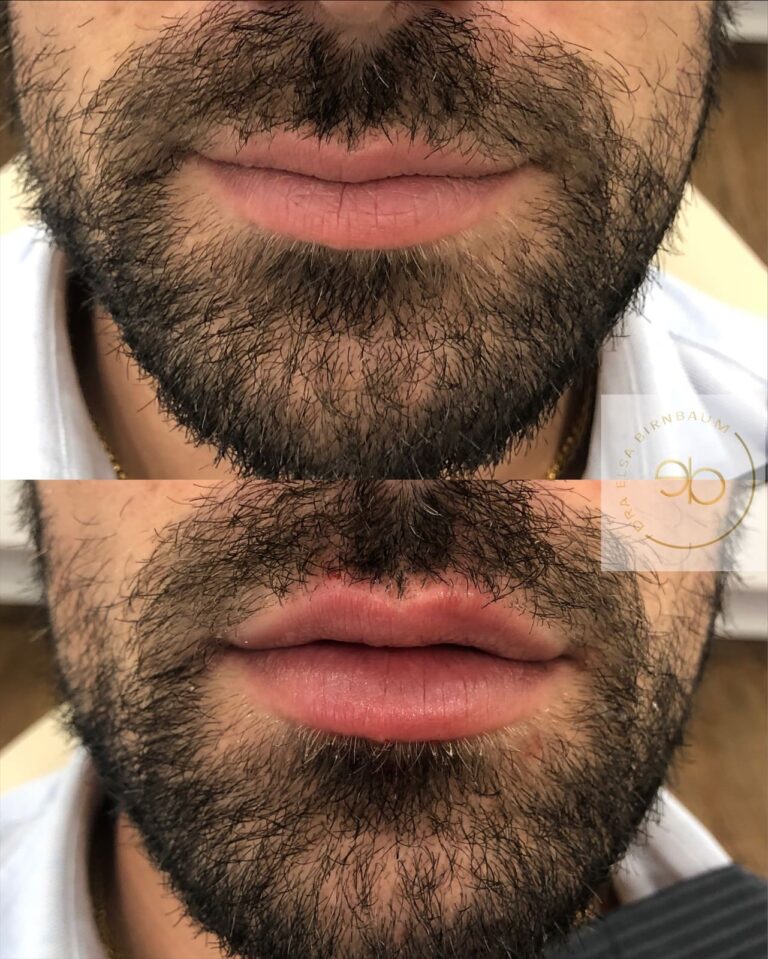 Ácido hialurónico en labios antes y después – Dra. Elsa Birnbaum, Madrid
