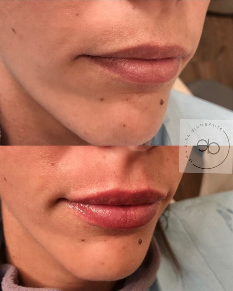 Ácido hialurónico en labios antes y después – Dra. Elsa Birnbaum, Madrid