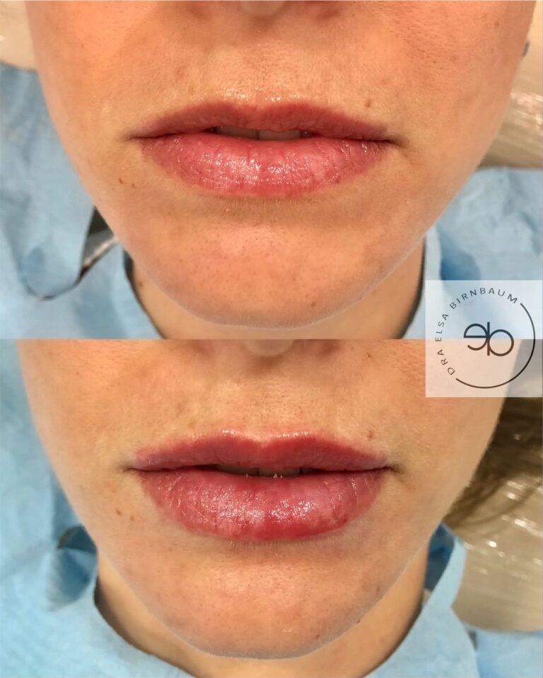 Ácido hialurónico en labios antes y después – Dra. Elsa Birnbaum, Madrid
