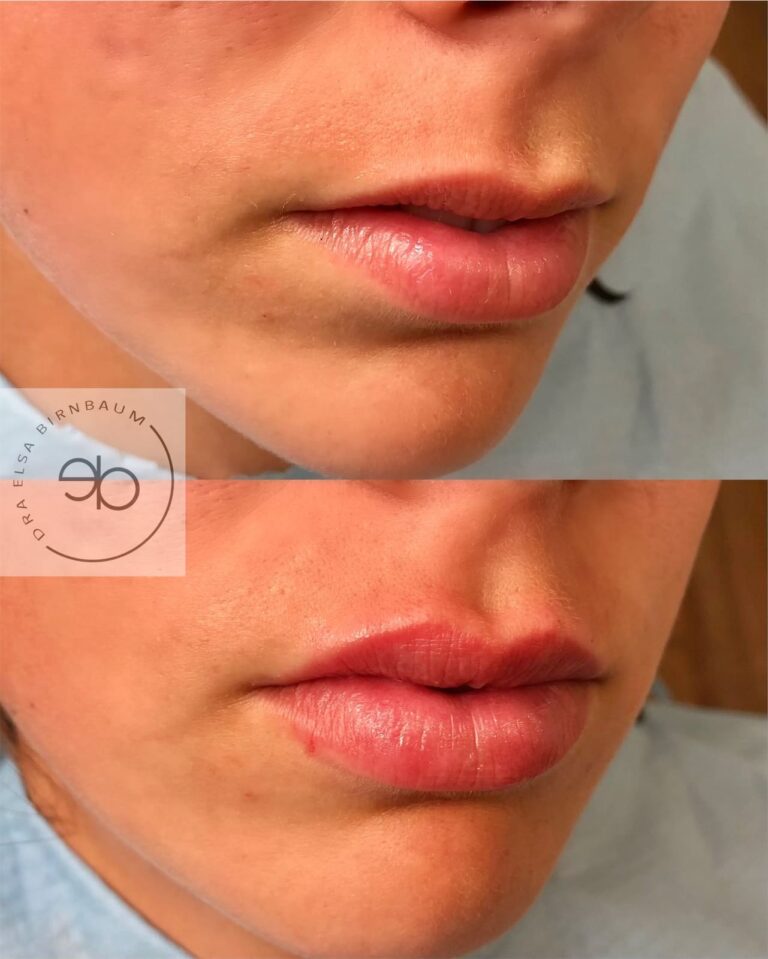 Ácido hialurónico en labios antes y después – Dra. Elsa Birnbaum, Madrid