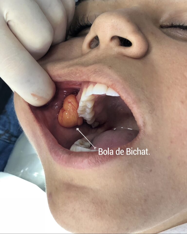 Bola de Bichat extraída en una bichectomía – Dra. Elsa Birnbaum
