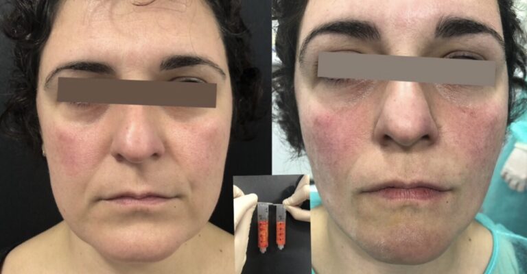 Bichectomía antes y después – Dra. Elsa Birnbaum, Madrid