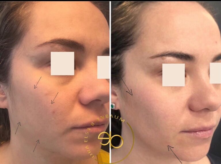 Bichectomía antes y después – Dra. Elsa Birnbaum, Madrid